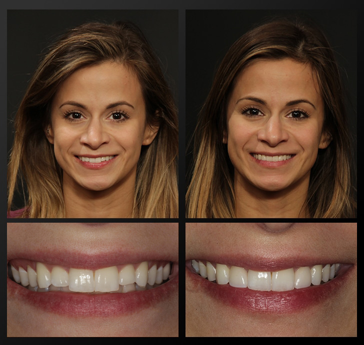 - Rochester Advanced Dentistry - Rochester Advanced Dentistry Emily's portrait and smile close up before and after dental treatment whitens and evens teeth